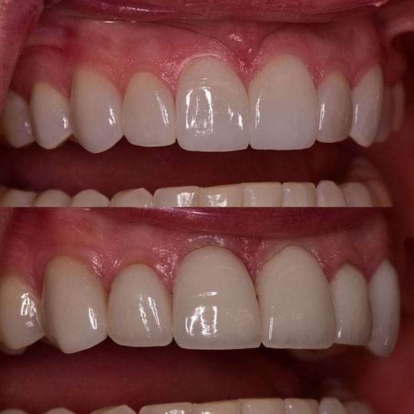 veneers-1-2