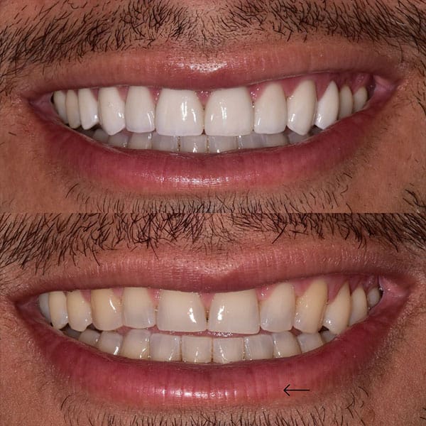 smile-makeover-ba-1 Smile makeover before and after images show whiter teeth on an Orlando patient.