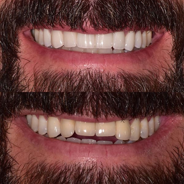 smile-makeover-ba-2 An Orlando patient shows the results of his smile makeover.