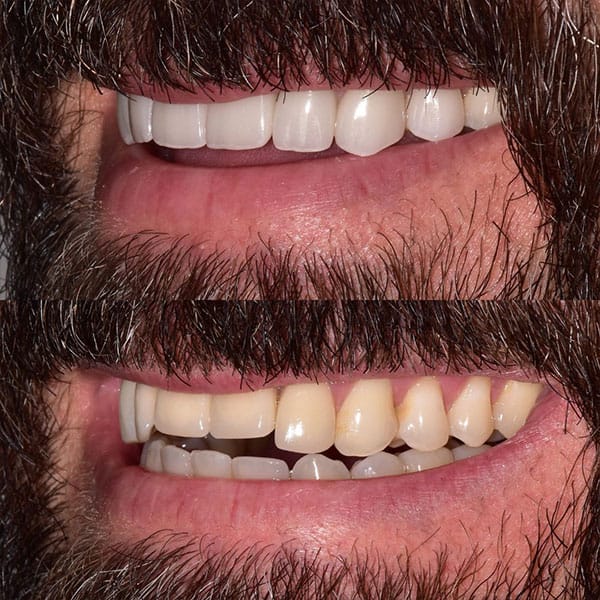smile-makeover-ba-3 Smile makeover before and after results of an Orlando patient.