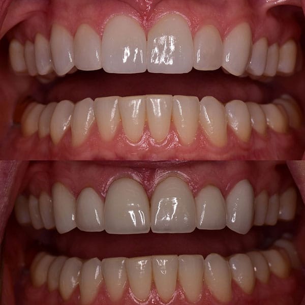 smile-makeover-ba-4 Patient before and after of an Orlando smile makeover.