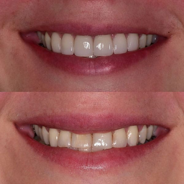smile-makeover-ba-5 Improved veneers after a smile makeover in Orlando.