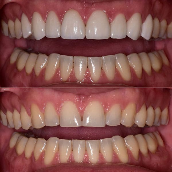 smile-makeover-ba-6 Before and after results of a smile makeover in Orlando.