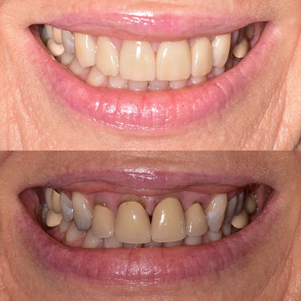 restorative-dentistry-orlando-b-a-3 Before and after results of crown replacement, a restorative dentistry procedure in Orlando.