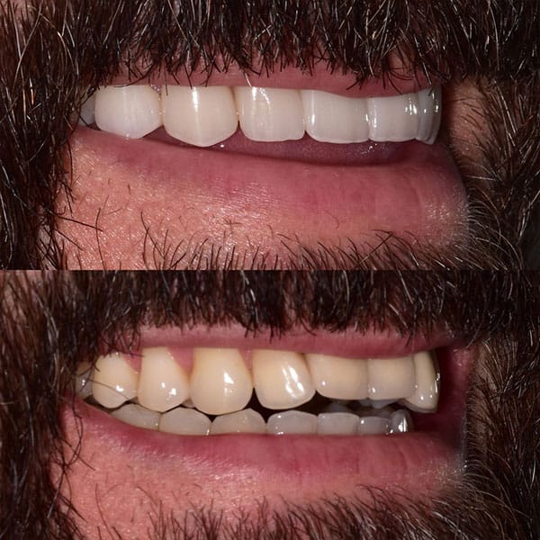 restorative-dentistry-orlando-before-after-1 Patient before and after results of new crowns after restorative dentistry in Orlando.