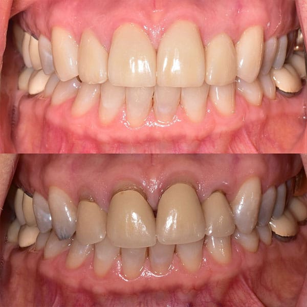 restorative-dentistry-orlando-before-after-2 Before and after results of a patient who underwent restorative dentistry in Orlando.